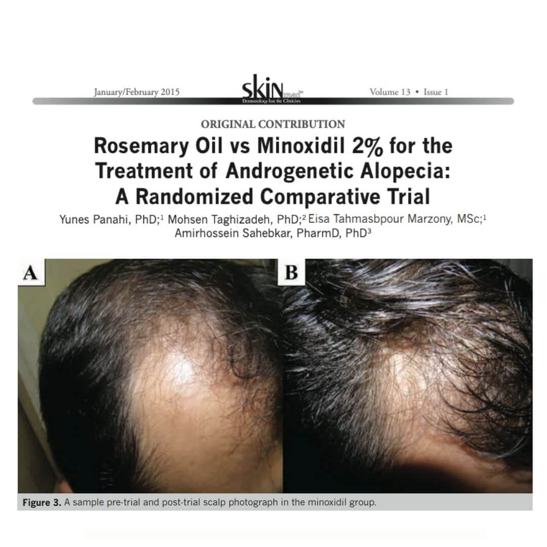 Rosemary Oil Vs Minoxidil